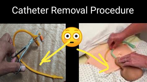 The <b>catheter</b> can be indwelling—left in your bladder for a short or long time, or intermittent—inserted to drain the bladder when needed and then removed. . Catheter removal procedure